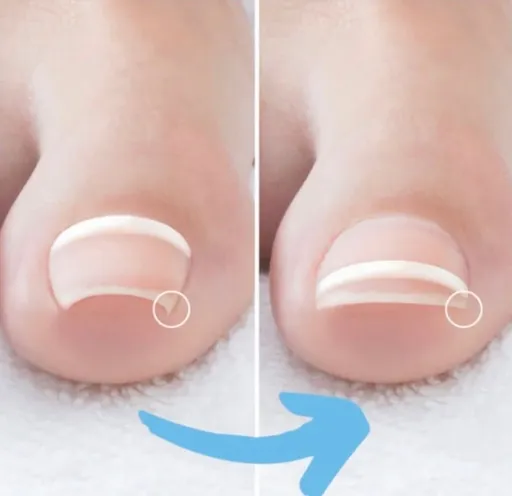 Onyfix Nagelkorrektur: links ein eingerollter Zehennagel vor der Behandlung, rechts der begradigte Nagel danach